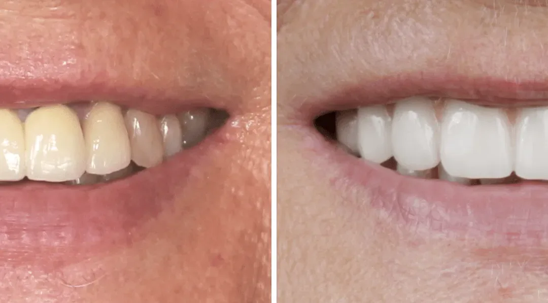 Caso Clínico — Implantologia, Estética Dentária e Oclusão