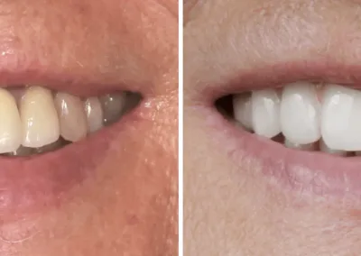 Caso Clínico — Implantologia, Estética Dentária e Oclusão