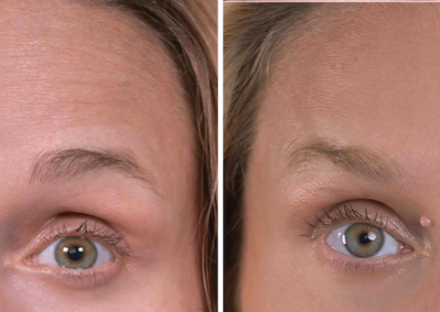 Caso Clínico — Aplicação de Botox®