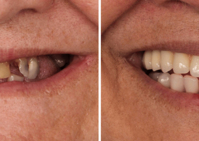 Caso Clínico — Prótese Fixa sobre Implantes Dentários