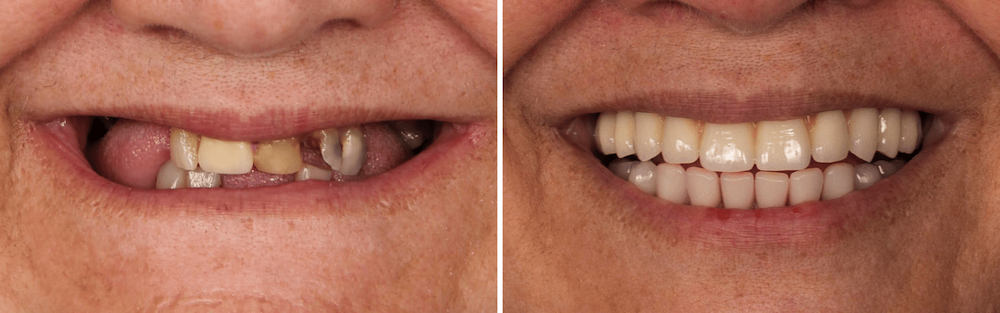 Caso Clínico — Prótese Fixa sobre Implantes Dentários