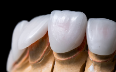 Facetas dentárias: preço e qualidade dos materiais