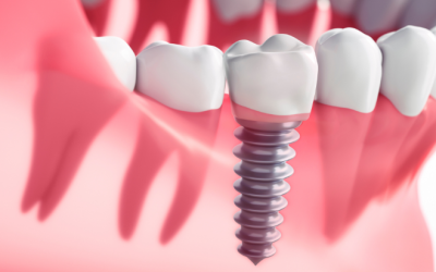 Retirar um dente e colocar um implante no próprio dia