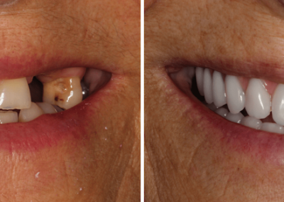 Caso Clínico — Reabilitação Fixa sobre Implantes Dentários