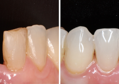 Caso Clínico — Facetas em Compósito e Branqueamento Dentário