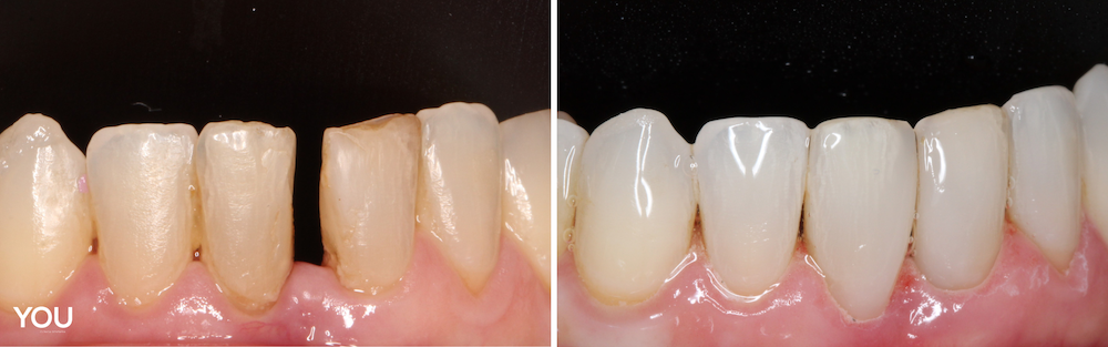 #45 Facetas em Compósito e Branqueamento Dentário