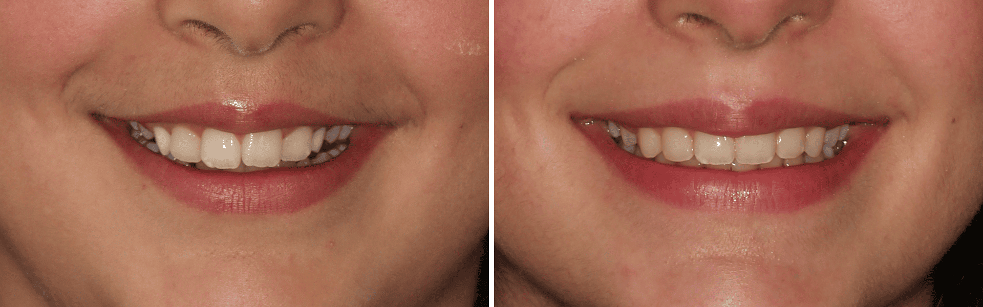 you clínica dentária-aparelho dentário fixo Aparelho dentário fixo