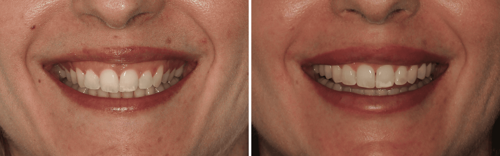 you clínica dentária-aparelho dentário invisível Aparelho dentário invisível