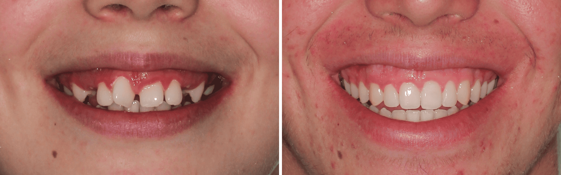 you clínica dentária-aparelho dentário invisível Aparelho dentário invisível