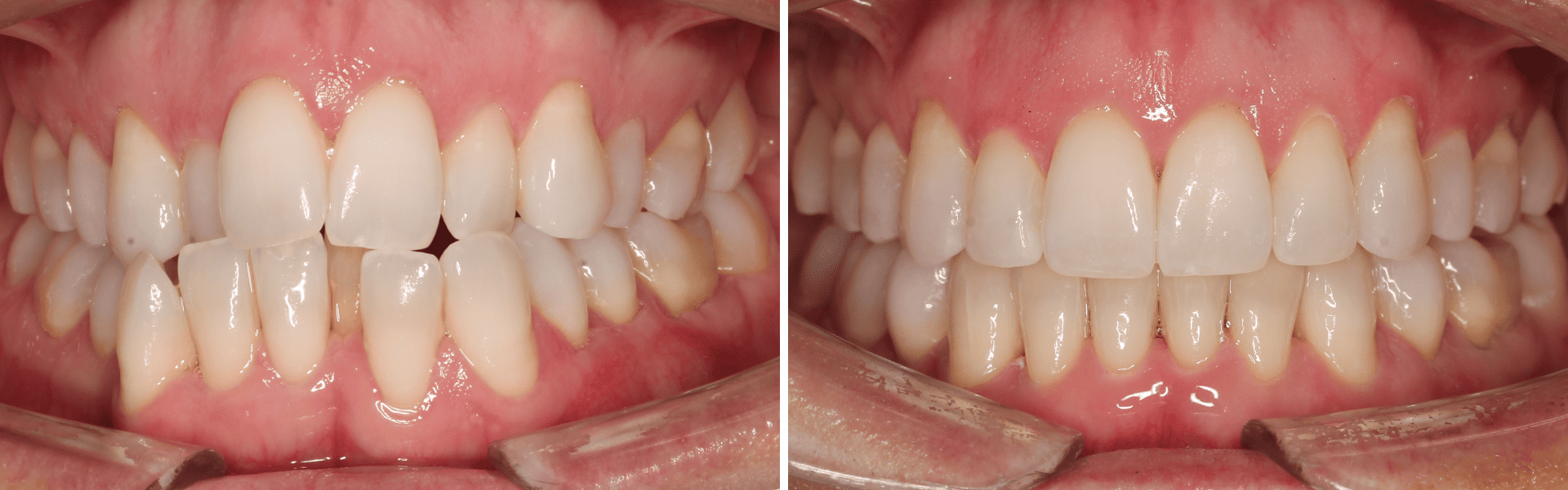 you clínica dentária-aparelho invisível Aparelho invisível