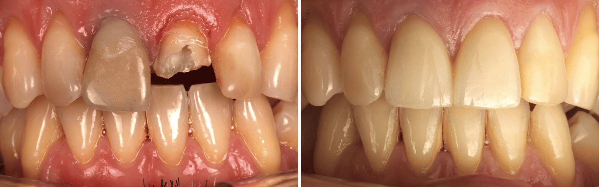 you clínica dentária-branqueamento interno Branqueamento interno e coroas dentárias