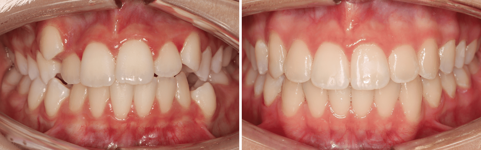 you clínica dentária-caso clínico alinhadores transparentes Aparelho invisível