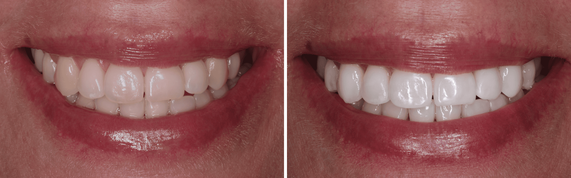 Branqueamento dentário