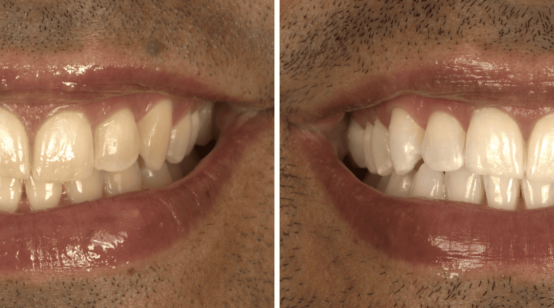 Caso Clínico — Branqueamento dentário