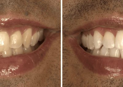 Caso Clínico — Branqueamento dentário