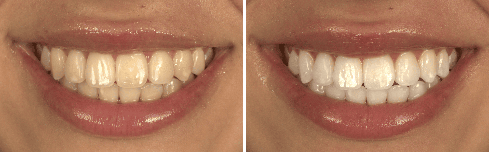 you clínica dentária-caso clínico branqueamento dentário joana freire Branqueamento dentário