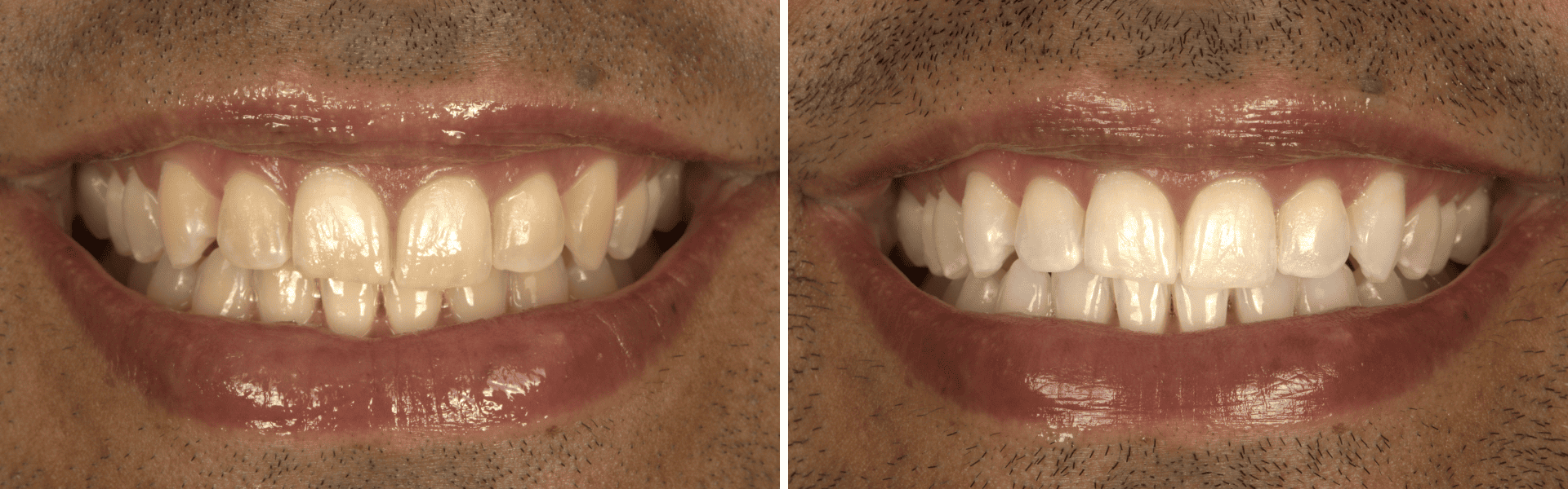 you clínica dentária-caso clínico branqueamento dentário branqueamento dentário
