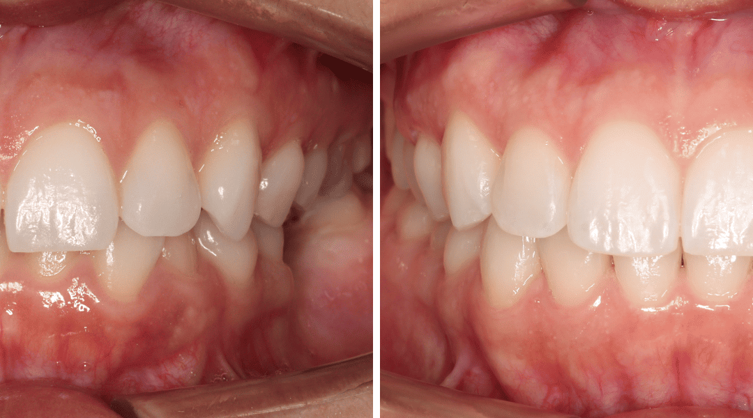 Caso Clínico — Dentisteria, Ortodontia e Implantologia