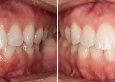 Caso Clínico — Dentisteria, Ortodontia e Implantologia