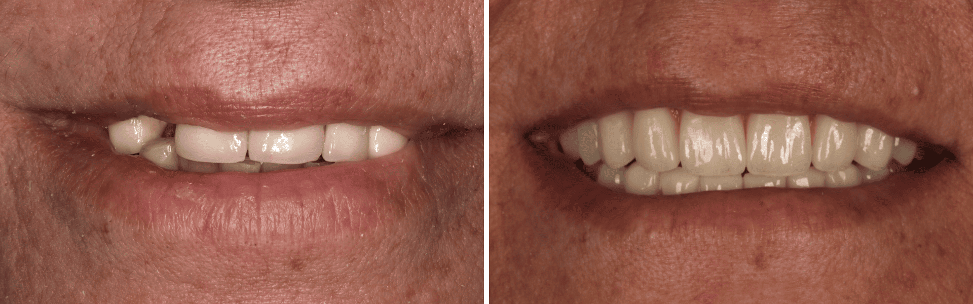 you clínica dentária-impantes dentários Implantes dentários