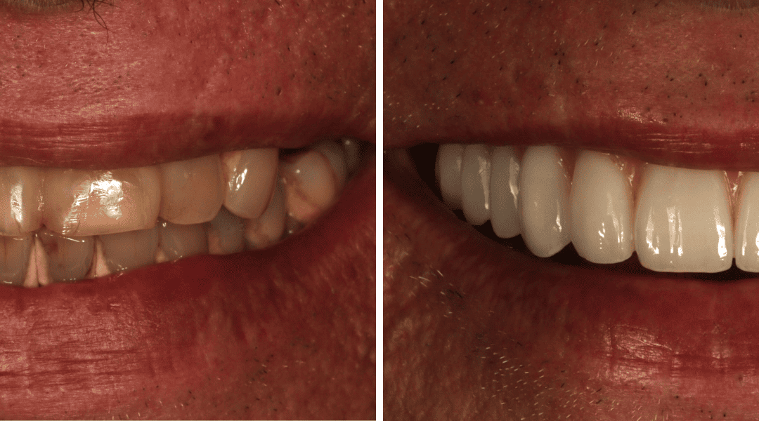 Caso Clínico — Implantes dentários