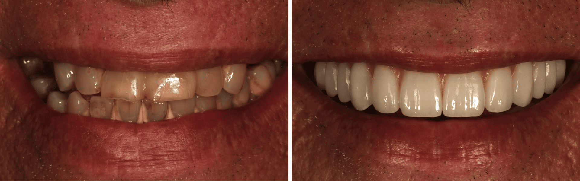 Implantes dentários