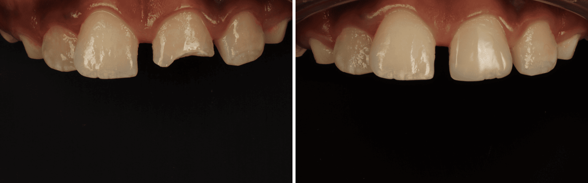 you clínica dentária-restauração direta em compósito Restauração direta em compósito