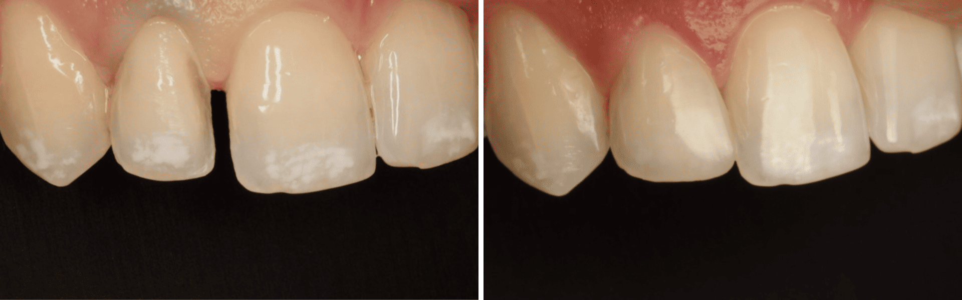 you clínica dentária-restauração direta estética Restauração direta estética