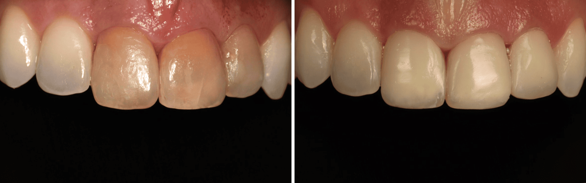 you clínica dentária-restaurações diretas em compósito Restaurações diretas em compósito
