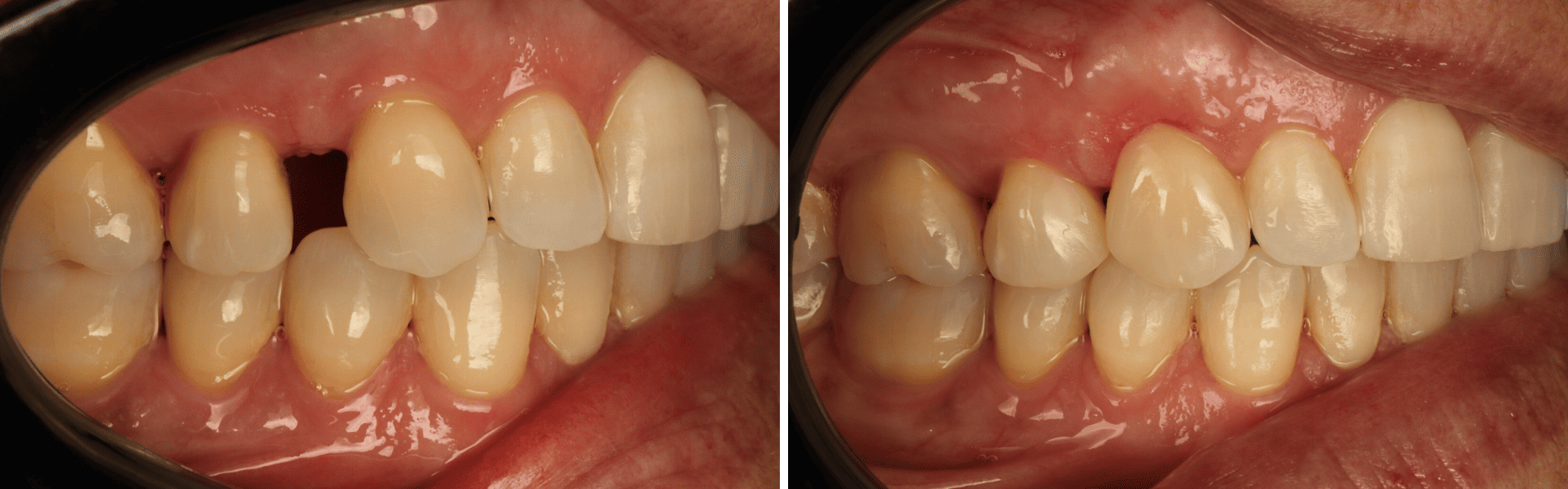 you clínica dentária-restaurações diretas em resina composta Restaurações diretas em resina composta,