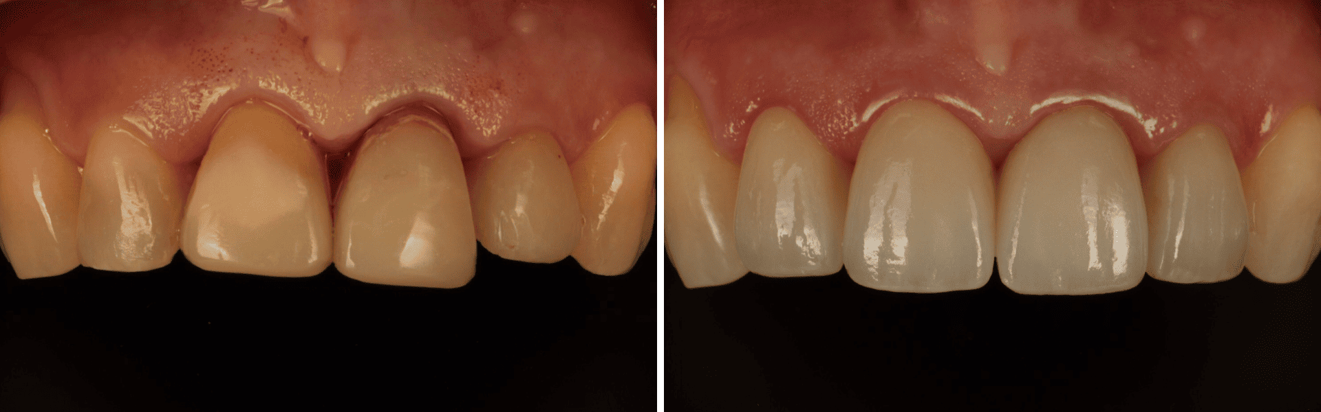 you clínica dentária-retratatamento endodôntico-coroas em cerâmica Retratatamento endodôntico coroas em cerâmica